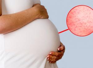 Симптомы простуды у беременных женщин
