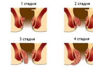 Trudności z hemoroidami u kobiet karmiących piersią